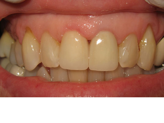 Restorative Dentistry After