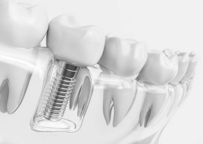 Dental Implants in Higganum, CT - Keith Campbell DMD